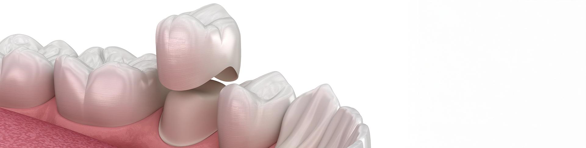 What to Expect During the Dental Crown Process | Sunridge Family Dental | Calgary Family Dentist | Calgary AB